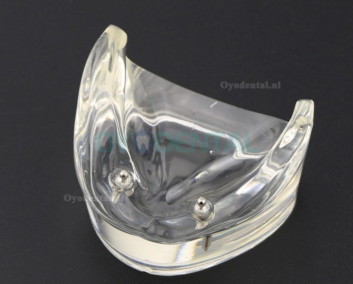 Tandentandenmodel Overdenture Inferieur met 2 implantaten Studiedemo Model 6002 01